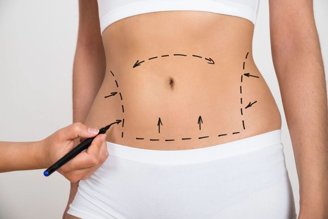Marking on the abdomen before liposuction, correction of the figure